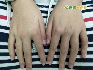 皮膚紅疹未必是過敏 恐因皮肌炎惹禍